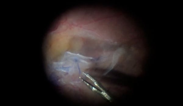 Double Stain With Brilliant Blue for Taut Macular Pucker thumbnail
