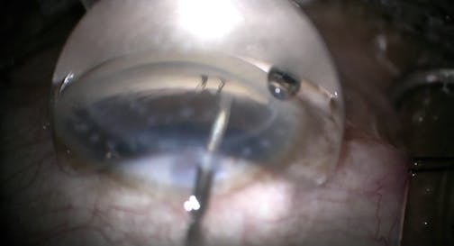 Kahook Dual Blade Following Penetrating Keratoplasty