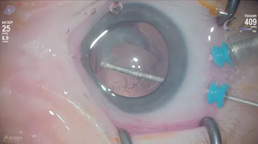 Congenital Cataract and Down Syndrome