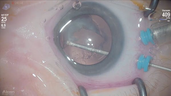 Congenital Cataract and Down Syndrome thumbnail