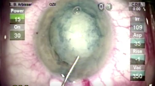 Ruptured Capsule Following PPV and Trabeculectomy