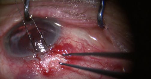 Open Revision of Previously Placed Xen Gel Stent