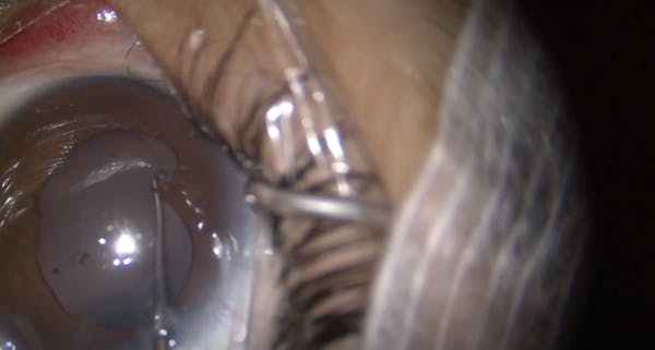 Omni Canaloplasty in Eye With Synechiae Break and Uveitic Glaucoma thumbnail