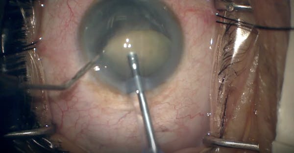 White Cataract thumbnail
