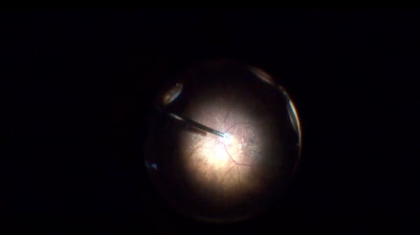 Atrophic Macular Hole With nAMD thumbnail