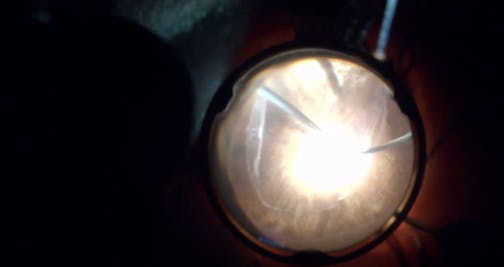 Triple Procedure for a PVR Stage D Retinal Detachment