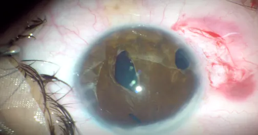 Pupilloplasty in Eye With Axenfeld-Rieger Syndrome