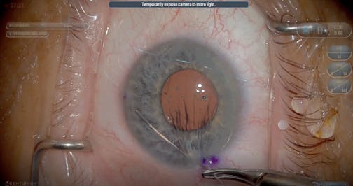 Siepser Knot for a Transillumination Defect