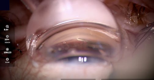 Hydrus Microstent Teaching Video