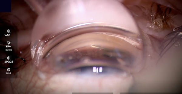 Hydrus Microstent Teaching Video thumbnail