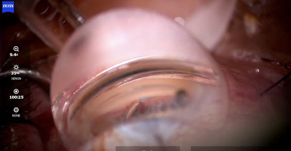 Omni Surgical System Teaching Video thumbnail