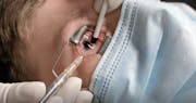 Complex Pediatric Pneumatic Retinopexy