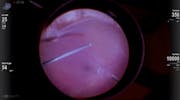 Retinal Incarceration in the Eye of a Pediatric Patient