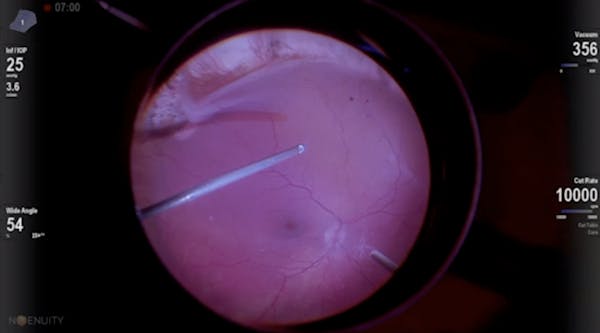 Retinal Incarceration in the Eye of a Pediatric Patient thumbnail