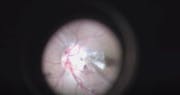 Surgical Technique for Pediatric Optic Disc Pit Maculopathy