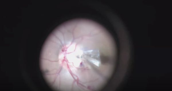 Surgical Technique for Pediatric Optic Disc Pit Maculopathy thumbnail