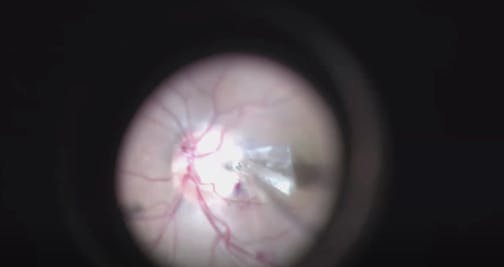 Surgical Technique for Pediatric Optic Disc Pit Maculopathy
