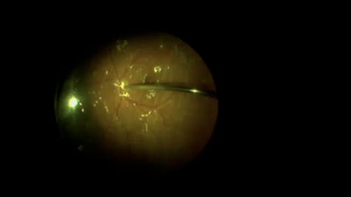 Giant Retinal Tear Repair