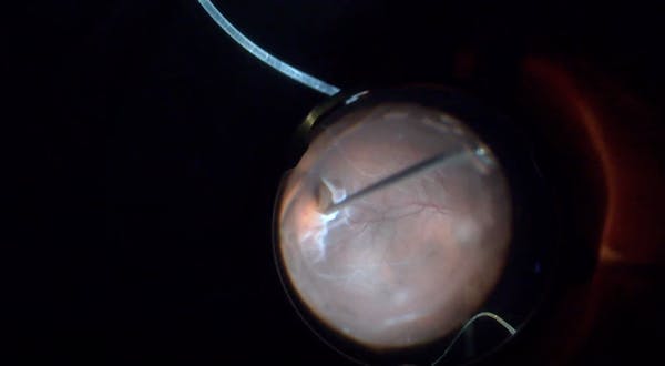 PVR-Related Recurrent Retinal Detachment thumbnail