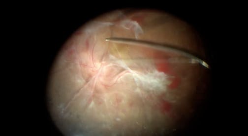 En Bloc Removal of Fibrovascular Tissue in Severe Tractional Retinal Detachment