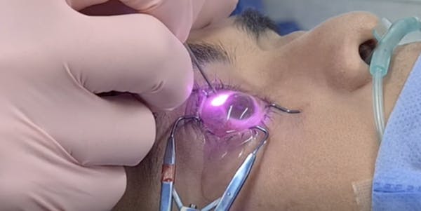 Cyclophotocoagulation and Goniotomy in Axenfeld-Rieger Syndrome thumbnail