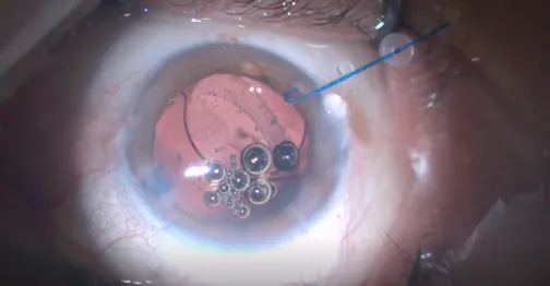 IOL Reposition With Double-Flanged Technique