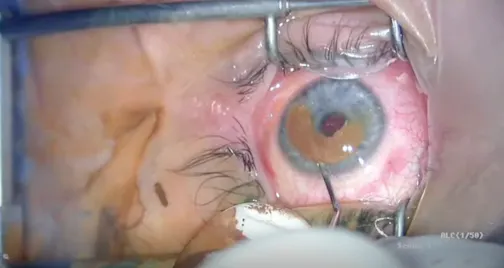 Femtosecond Laser-Assisted Corneal Tattooing in Patient With Congenital Heterochromia