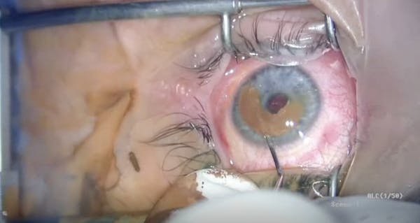 Femtosecond Laser-Assisted Corneal Tattooing in Patient With Congenital Heterochromia thumbnail