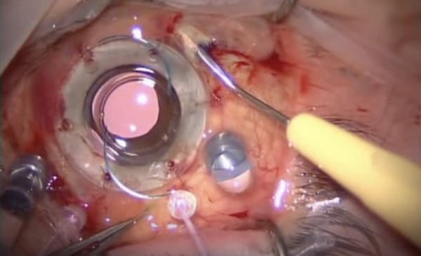 IOL Extraction and Sutureless Scleral Fixation of IOL With Keratoprosthesis thumbnail