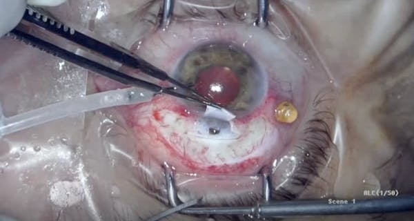 Pars Plana Lensectomy and Anterior Vitrectomy With Trabeculectomy thumbnail