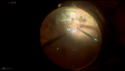 Recurrent Retinal Detachment Under Silicone Oil