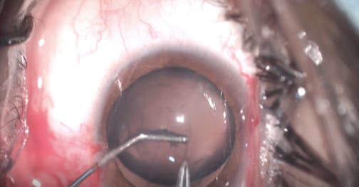 Bag Handle Capsulorhexis Technique