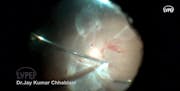 Chandelier-Assisted Vitrectomy and Core PPV