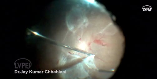 Chandelier-Assisted Vitrectomy and Core PPV