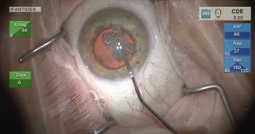 Siepser Iris Protector Ring - Eyetube