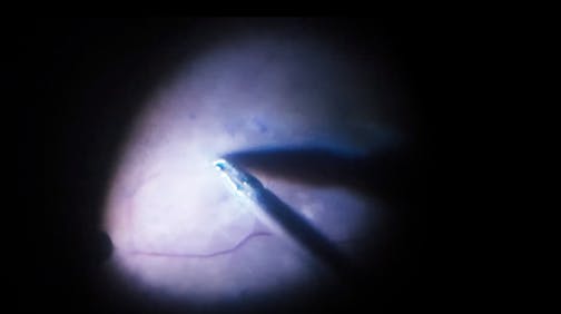 Challenging Vitrectomy for Taut and Contracting Epiretinal Membrane