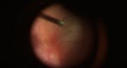 Subretinal tPA for the Treatment of Subretinal Hemorrhage