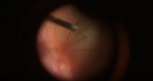 Subretinal tPA for the Treatment of Subretinal Hemorrhage