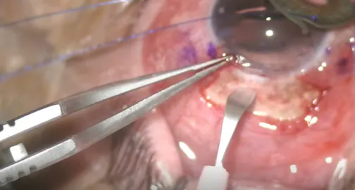 Artificial Iris and IOL Implantation