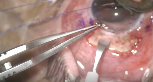 Artificial Iris and IOL Implantation thumbnail