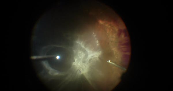 Chronic Combined Diabetic TRD and RRD thumbnail