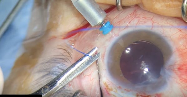 Canabrava's Double-Flange Polypropylene Technique thumbnail