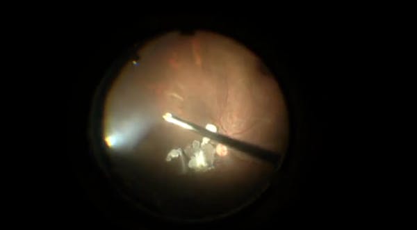 Pars Plana Lensectomy and IOL Implantation thumbnail
