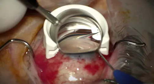 iTrack Advance in Combination With Cataract Surgery