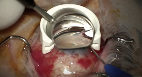 iTrack Advance in Combination With Cataract Surgery thumbnail
