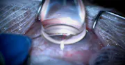 Canaloplasty and Double Hydrus Implantation