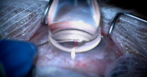 Canaloplasty and Double Hydrus Implantation