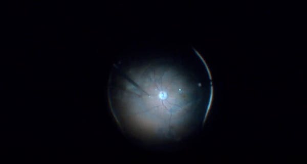 Standard Approach to Retinal Detachment With PVR thumbnail