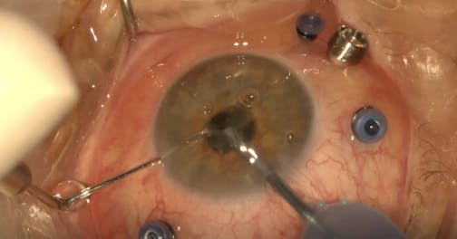 Vitrectomy for Failed Pneumatic Retinopexy