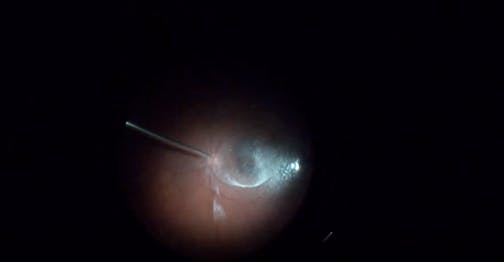 Submacular Hemorrhage-Related Macroaneurysm With Giant Retinal Tear